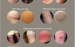 cdc rash and symptoms